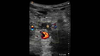 Popliteal Deep Venous Thrombosis - Ultrasound Image Interpretation