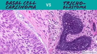 Hair Follicle Tumors vs Basal Cell Carcinoma Made Simple: 5-Minute Pathology Pearls Dermpath