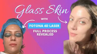 Laser Face Lift I Laser Face Treatment I Fotona 4D laser treatment before & after