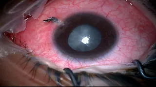 Rupture Globe repair with traumatic cataract extraction