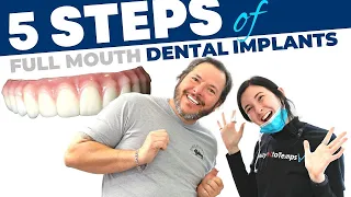 Full Mouth Dental Implant Procedure Step-by-Step