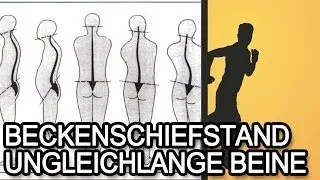 Beckenschiefstand und ungleichlange Beine - Ursache & Symptome