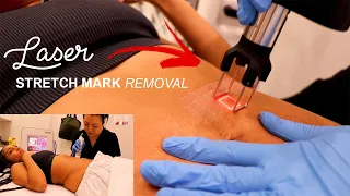 I got LASER STRETCH MARK REMOVAL (GRAPHIC CONTENT) J MAYO