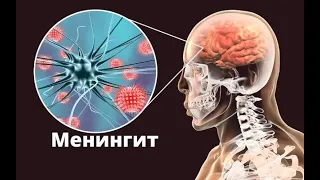 Менингит – причины, симптомы, осложнения и что делать