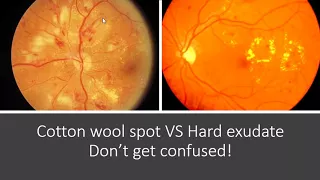 Classification of Diabetic Retinopathy