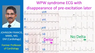 WPW syndrome ECG with disappearance of pre-excitation later