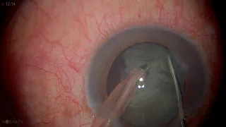 Surgery: Phacoemulsification in Dense Cataract