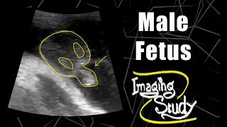 Male Fetus - Its a Boy || Ultrasound || Case 56