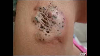 The best acne and blackheads Compilation 2023 Part 2 #AcneDoctor #Compilation