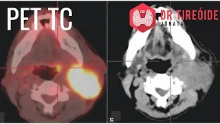 PET ou PET-TC - Entenda como é esse exame e porque ele é tão importante!