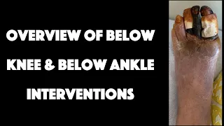 Overview of Below Knee & Below Ankle Interventions