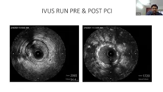 Best of Interventional Cases 2021 - What is Right for Left Main? Unique Challenges