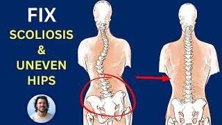 Scoliosis, uneven hips, pelvic imbalance, torsion | Causes & Fixes