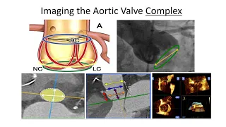 Aortic stenosis: Lessons from the Heart Team on TAVR, SAVR, HALT and beyond (Joint Session with TCT)