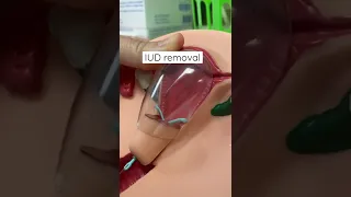 IUD removal