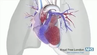 What is pulmonary hypertension?