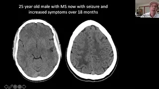 Innovation/Research Talk: Risto Filippi "Multiple Sclerosis"