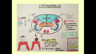 Syringomyelia - CRASH! Medical Review Series