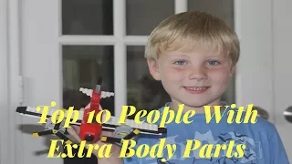 Top 10 People With Extra Body Parts