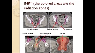 Cancer of the Vulva