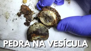 PEDRA NA VESÍCULA TEM QUE OPERAR? É PERIGOSO?