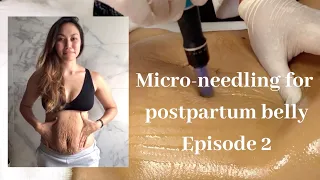 {Master Ruth} Micro needling for postpartum belly - Ep 2