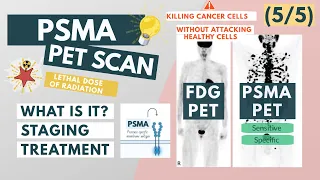 What is a PSMA PET scan? | Overview for Med Students | Urology