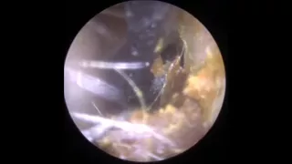 Gentle ear wax removal with Jobson Horne Probe