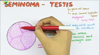 Seminoma Testis - Histopathology ; gross ; cross section; microscopic appearance