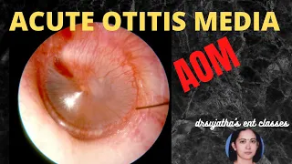 036. ASOM  #Acute Suppurative Otitis Media