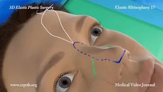 3D Elastic Rhinoplasty