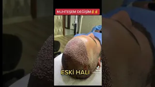 EN İYİ SAÇ EKİM SONUÇLARI,hairtransplantation,saçekimi,