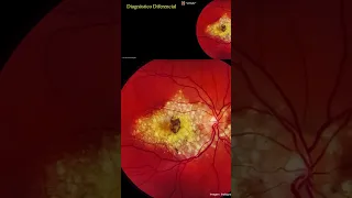 Diagnóstico de la Malattia Leventinese.