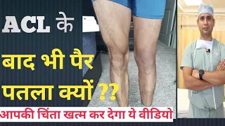 ACL सर्जरी के बाद भी पैर पतला क्यों? / अपने पैर को आप मोटा कैसे करे सर्जरी के बाद ?