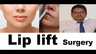 Lip Lift in India! Doctor, clinic, Cost, Post Lip lift care!