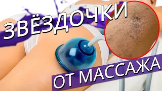 Сосудистые звездочки от вакуумного массажа.