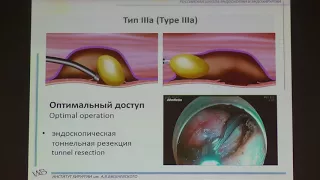 18 Замолодчиков РД Современные методы эндоскопического удаления неэпителиальных опухолей желудка