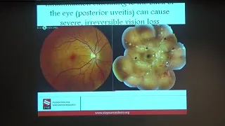 Dr. Amol Sura - Ocular Sarcoidosis
