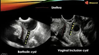 Gynaecological Ultrasound: Step by Step Part 1