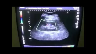 SUBCUTANEOUS ABSCESS LT LUMBAR REGION post LT Nephectomy