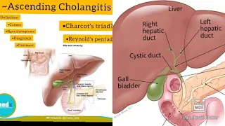 Ascending Cholangitis|Medx