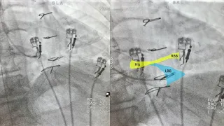 left bundle branch pacing technique (LBBP)