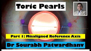 Toric IOL pearls Part 1 Misaligned reference axis Dr Sourabh Patwardhan