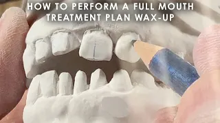 How to perform a Full Mouth Treatment Plan Wax-Up
