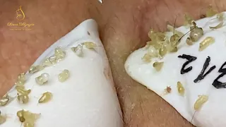 Loan Nguyen Acne Treatment (#124)