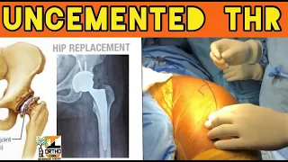 Uncemented Total Hip Replacement surgery step by step ( modified Hardinge / Lateral approach to Hip)