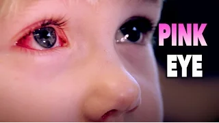PINK EYE vs ADORABLE GIRL | Dr. Paul