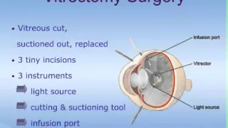 Indications for Vitrectomy