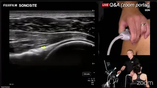 Diagnostic Shoulder Ultrasound: Part 3 - Posterior Shoulder