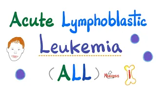 Acute Lymphoblastic Leukemia (ALL) | Down Syndrome | tDt positive